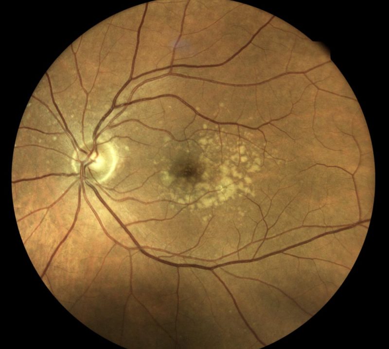 ARMD Wet & Dry AgeRelated Macular Degeneration KindSIGHT