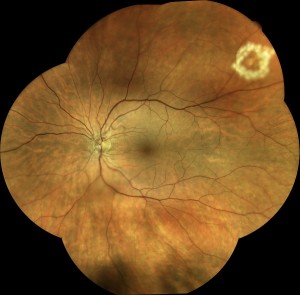 Retinal laser (white circle) surrounding a small peripheral retinal tear.