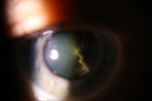 Eye with large floater