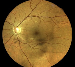 Retina with floaters