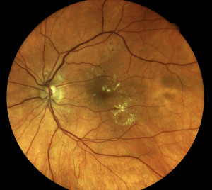 Diabetic changes at the macula