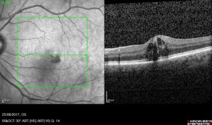 Diabetic swelling of the macula on OCT scan