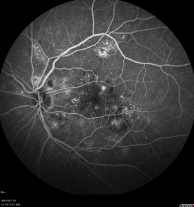 Fluorescein angiography (dye test)