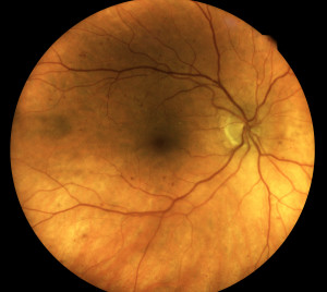 Mild diabetic retinopathy with small haemorrhages