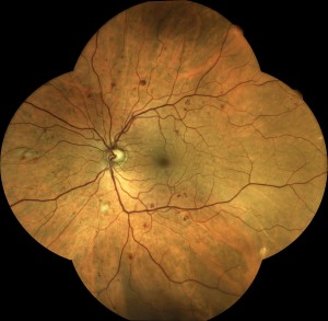 Moderate background diabetic retinopathy