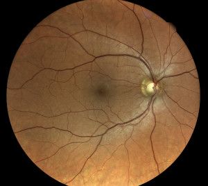 Normal appearance of the retina