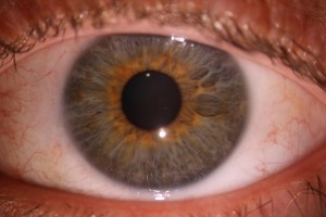 Eye After pterygium surgery