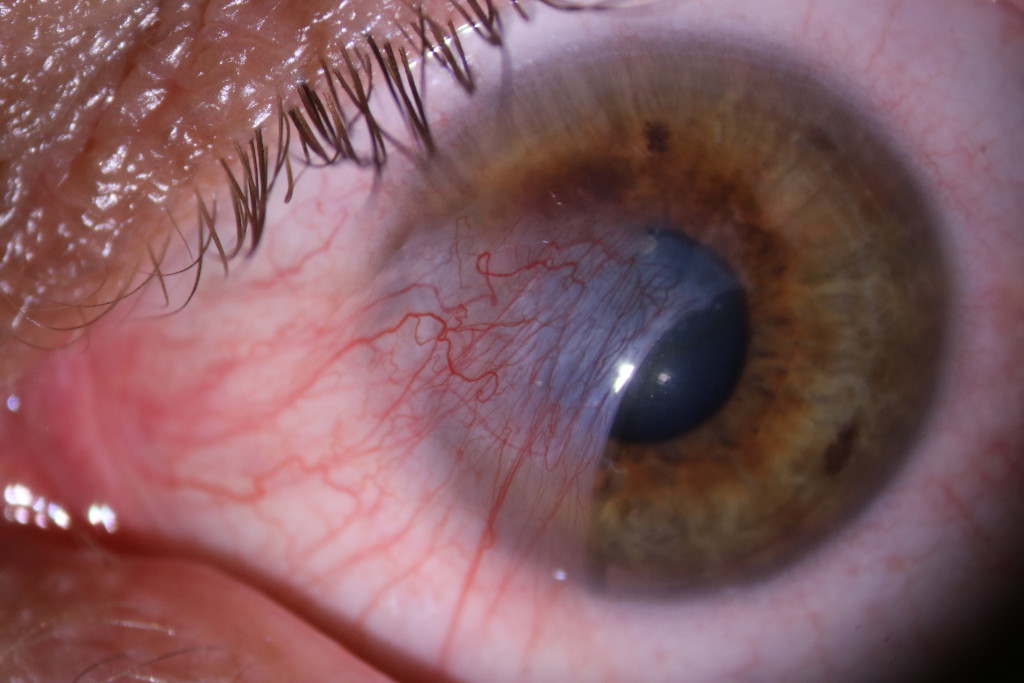 Do You Need Pterygium Surgery? | KindSIGHT Eye Specialists