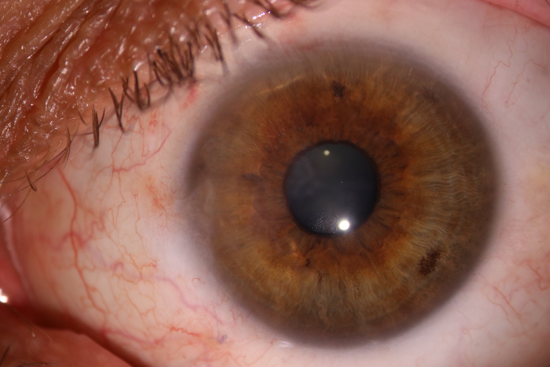 Do You Need Pterygium Surgery? | KindSIGHT Eye Specialists