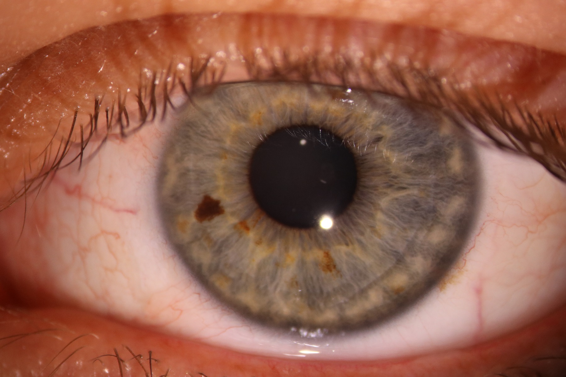 Do You Need Pterygium Surgery? | KindSIGHT Eye Specialists