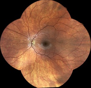 Retinal photo with a dilated eye (pupil)