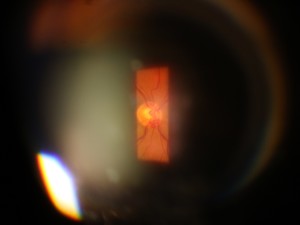 Slit Lamp Photo of Optic Nerve Undilated