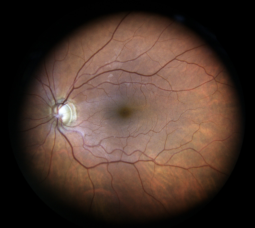 Visual Field Test Sight saving Exam KindSIGHT Eye Specialists