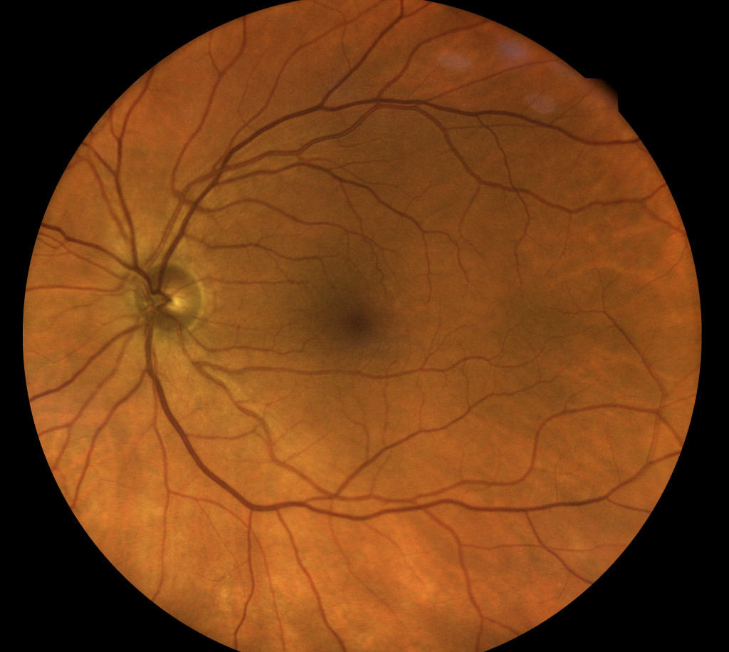 Retinal photo showing a normal optic nerve