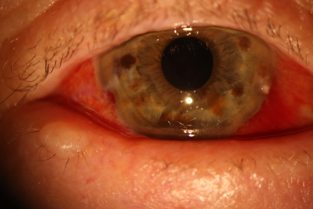 Subconjunctival haemorrhage stress