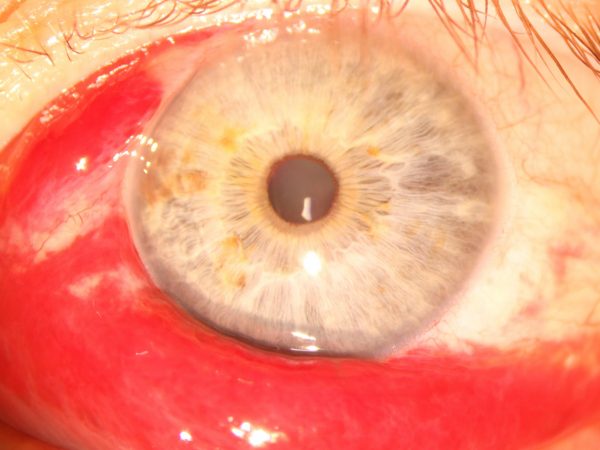 Subconjunctival Haemorrhage 