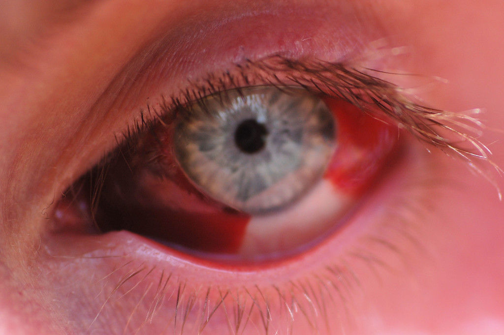 Subconjunctival haemorrhage stress