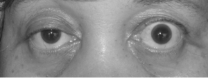 Right eye ptosis