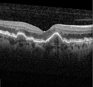 ARMD Wet & Dry Age-Related Macular Degeneration | KindSIGHT