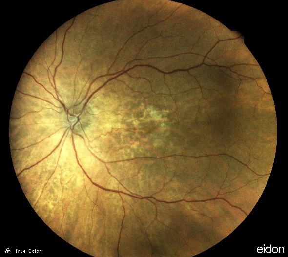 ARMD Wet & Dry Age-Related Macular Degeneration | KindSIGHT