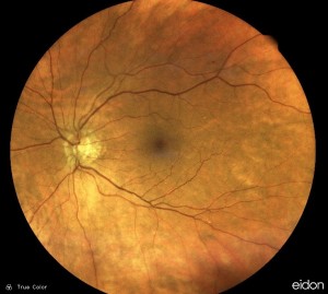 A retinal photo showing a normal macula