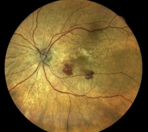 An example of wet ARMD with macula haemorrhaging