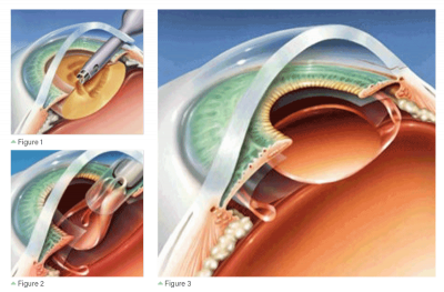 Cataract Surgery Guide | Causes, Treatment, IOLs | KindSIGHT