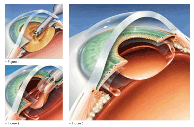 Cataract Surgery Guide Causes Treatment IOLs KindSIGHT