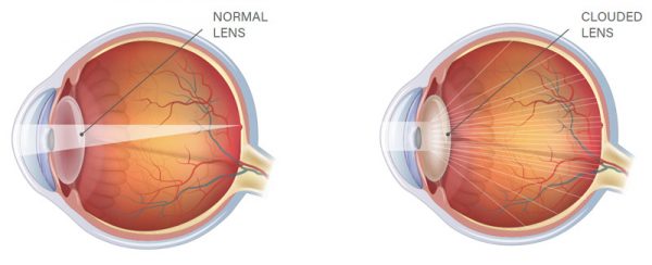 Cataract Surgery Guide | Causes, Treatment, IOLs | KindSIGHT