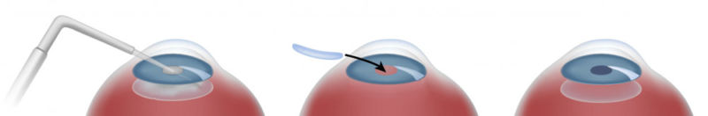 RLE - Refractive Lens Exchange | KindSIGHT Eye Specialists